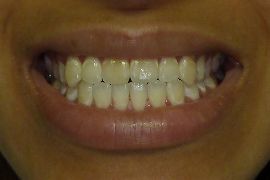 Clareamento Dental