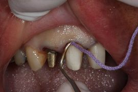 Afastamento mecânico com fio retrator duplo para moldagem de preparos subgengivais