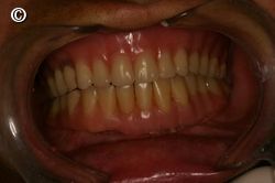 overdenture barra clip superior overdenture superior e inferior artigo ident overdenture barra clip superior overdenture superior e inferior artigo ident