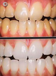 Clareamento caseiro antes e depois de 30 dias. Clareamento caseiro antes e depois de 30 dias.