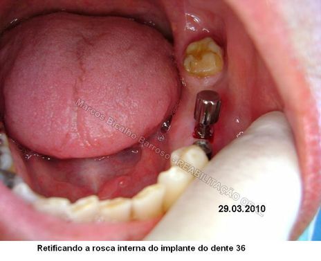 Se é possível aumentar um peito se ainda não deu à luz