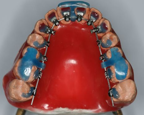 Curso de Capacitação em Ortodontia Lingual