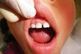 Restauração em Resina Composta dente 51