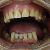 Foto inicial intra-oral com a PPR superior