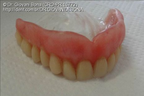 overdenture barra clip superior solu 231 227 o alternativa para protocolo superior flange overdenture barra clip superior solu 231 227 o alternativa para protocolo superior flange