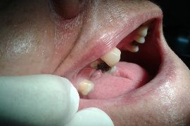 Reconstrução do dente 14 com pino de fibra de vidro e resina composta.