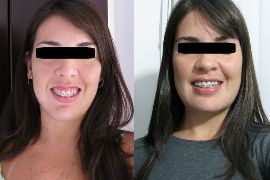 Sorriso Gengival - Gengivoplastia