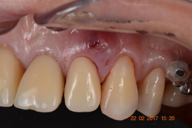 Fratura Dental em Regiao Estética