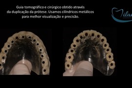 Confecção de Guia Cirúrgico e Tomográfico para Reabilitação Total Maxilar. Previsibilidade na Enxertia e Instalação da Prótese.