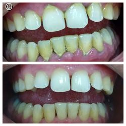 Tratamento Periodontal, Antes e Depois..., Caso clínico | iDent
