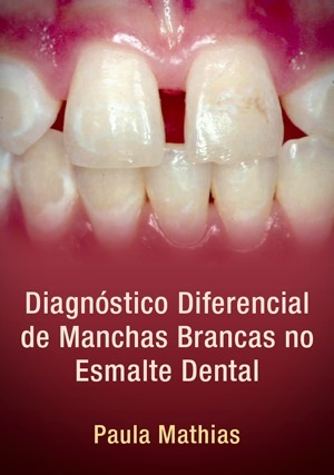 Diagnóstico Diferencial de Manchas Brancas no Esmalte Dental