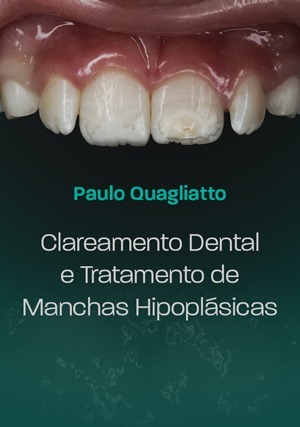 Clareamento Dental e Tratamento de Manchas Hipoplásicas
