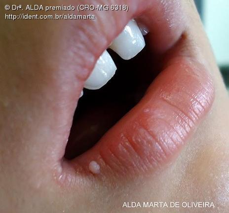 Infeccao Pelo Hpv Artigo Ident