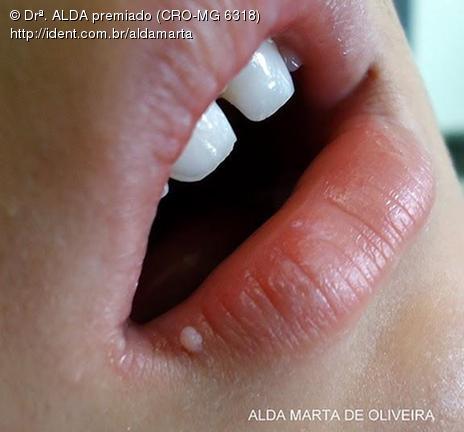 papiloma labial tratamento)