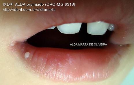 Infeccao Pelo Hpv Artigo Ident