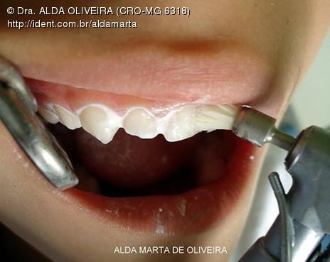Aplicação Tópica De Flúor