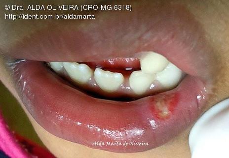 Lesao Traumatica Pos Anestesia Caso Clinico Ident