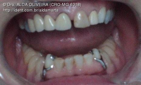 Dente 21 Pino Rosqueavel Provisorio Coroa Total Em Ceromero Caso Clinico Ident