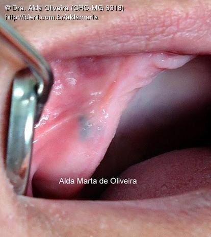 Artigo tatuagem por amalgama Tatuagem De Amalgama Caso Clinico Ident