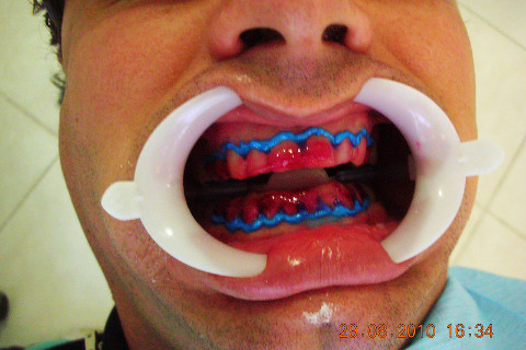40 minutos com o gel clareador, após limpeza dos dentes com um gel azul protetor de gengiva.