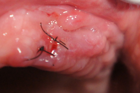 Beneficios Do L Prf Na Implantodontia Caso Clinico Ident
