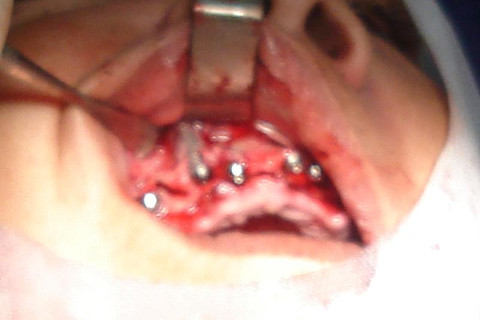 Protocolo superior, fenestrou, foi feito enxerto recobrindo todas as espiras, foto ruim, ruim nao, pessima! mas a paciente ja engordou 5 kg Protocolo superior, fenestrou, foi feito enxerto recobrindo todas as espiras, foto ruim, ruim nao, pessima! mas a paciente ja engordou 5 kg