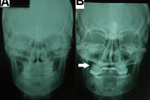 Posteroanterior radiograph. A- Prior to SARME. B- Following SARME showing greater asymmetric expansion on the right side Posteroanterior radiograph. A- Prior to SARME. B- Following SARME showing greater asymmetric expansion on the right side