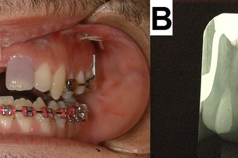 Photography and periapical radiography following SARME. (A) Front
view showing darkening of the left maxillary central incisor. (B) Periapical
radiographs of maxillary central incisors. Photography and periapical radiography following SARME. (A) Front
view showing darkening of the left maxillary central incisor. (B) Periapical
radiographs of maxillary central incisors.