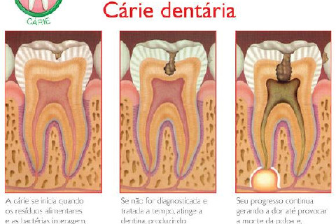 Estágios da Cárie Dentária Estágios da Cárie Dentária