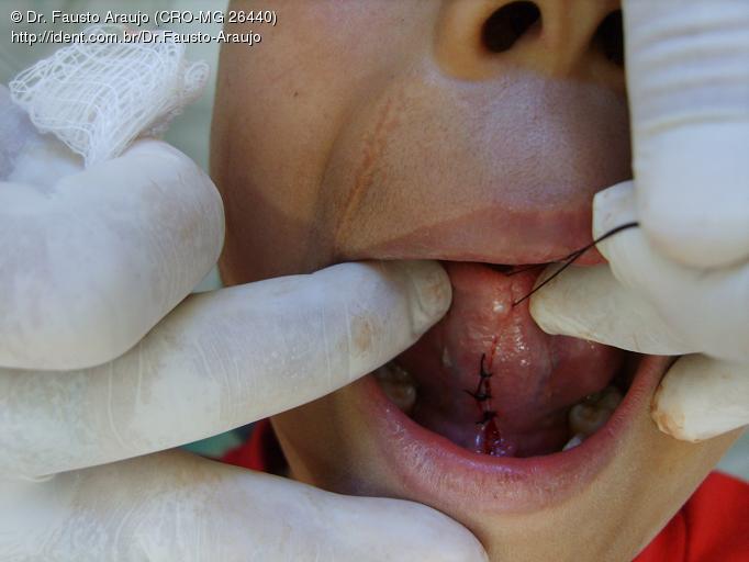 Frenectomia Lingual com Transfixação de Língua, Caso clínico iDent Frenectomia Lingual com Transfixação de Língua, Caso clínico iDent