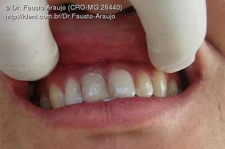Curetagem Apical Com Apicetomia Caso Clinico Ident