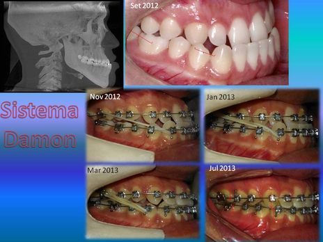 tratamento em 1a 5m, classe III sem cirurgia