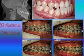 tratamento em 1a 5m, classe III sem cirurgia