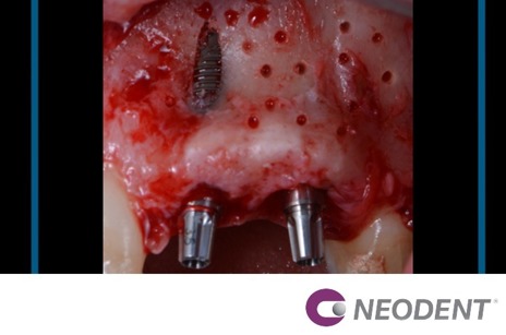 Regeneração Óssea Guiada e de Tecido Mole em Implantes Imediatos.