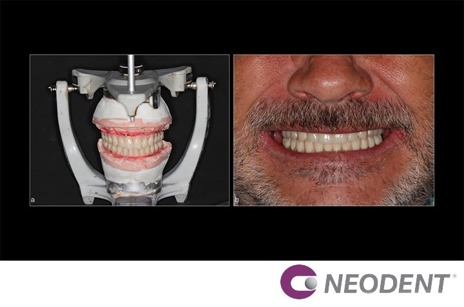 Reabilitação de Arco Total Duplo com Número Mínimo de Implantes Dentários Híbridos Helix Neodent
