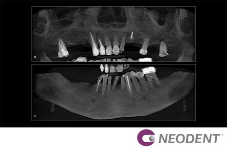 Reabilitação de Arco Total Duplo com Número Mínimo de Implantes Dentários Híbridos Helix Neodent