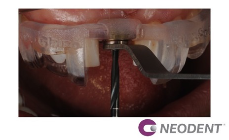 Cirurgia Guiada (Ngs) para a Instalação do Helix Gm com Carga Imediata, Após Remoção de Implante Mal Posicionado.