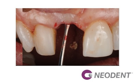 Cirurgia Guiada (Ngs) para a Instalação do Helix Gm com Carga Imediata, Após Remoção de Implante Mal Posicionado.