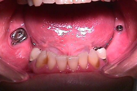 Prótese Removível ( inicialmente dentomucosuportada, depois dento implante suportada), utilização de raiz residual e implante para suporte. Prótese Removível ( inicialmente dentomucosuportada, depois dento implante suportada), utilização de raiz residual e implante para suporte.