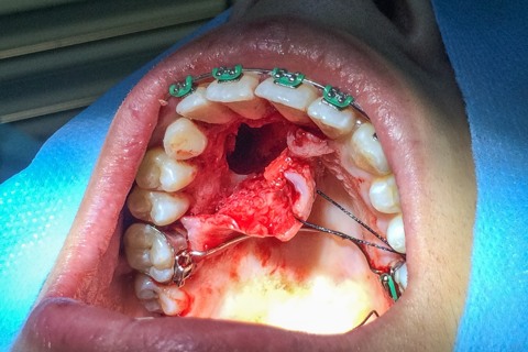 Aspecto clinico após exodontia Aspecto clinico após exodontia
