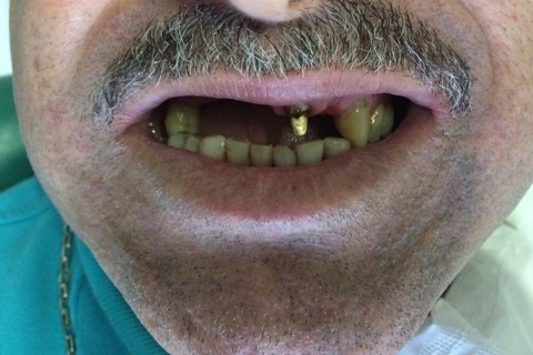 Confecção de coroa metalocerâmica para o elemento 21