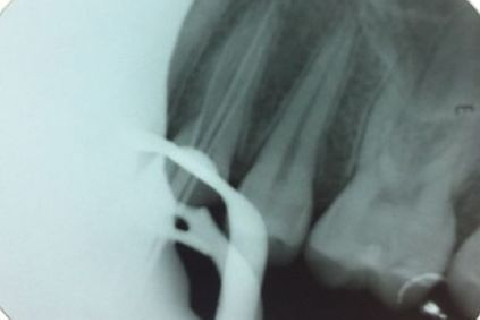 prova do cone - canal palatino que cortou no rx anterior prova do cone - canal palatino que cortou no rx anterior