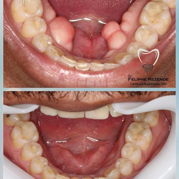 Exérese de Tórus Mandibular Bilateral, Caso