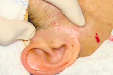 Acesso pré auricular