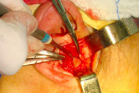 recaptura do disco articular.
