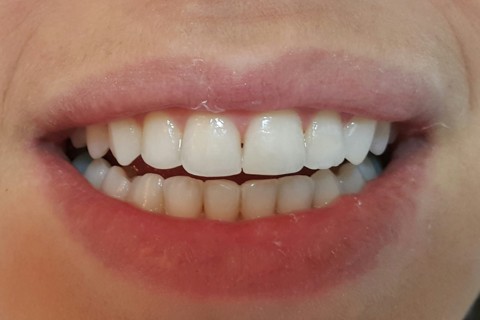 7 dias após clareamento dental e restauração elemento 23