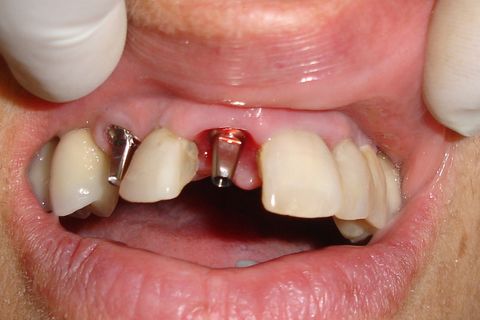 Coroas provisórias confeccionadas com os próprios dentes do paciente.
