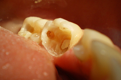 Completa remoção dos tecidos afetados pelas lesões de cárie, endodontia e selamento das entradas dos condutos: Dentes prontos para receberem o tratamento restaurador. Completa remoção dos tecidos afetados pelas lesões de cárie, endodontia e selamento das entradas dos condutos: Dentes prontos para receberem o tratamento restaurador.