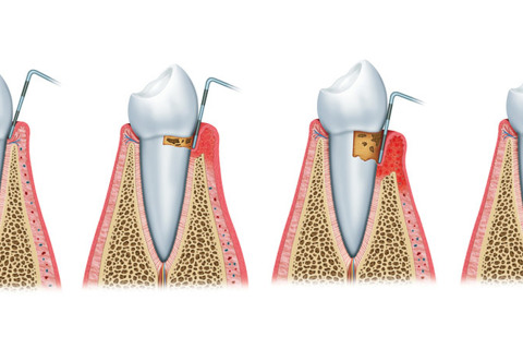 Evolução da doença: comprometimento de gengivas, ligamento e osso, levando à perda gradativa de inserção do dente. Evolução da doença: comprometimento de gengivas, ligamento e osso, levando à perda gradativa de inserção do dente.