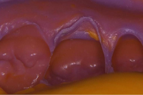 Molde em silicona de adição, ntidez das margens do preparo.